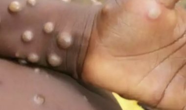 मंकीपॉक्स व्हायरस वर औषध सापडलं